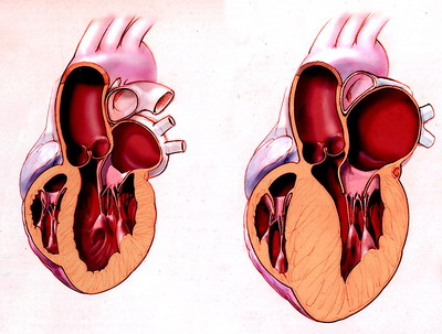 Cardiomiopatie dilatativa